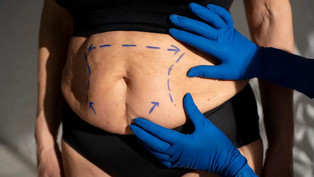 What is a Tummy Tuck Procedure?