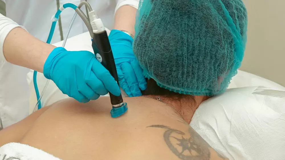 types of tattoo removal