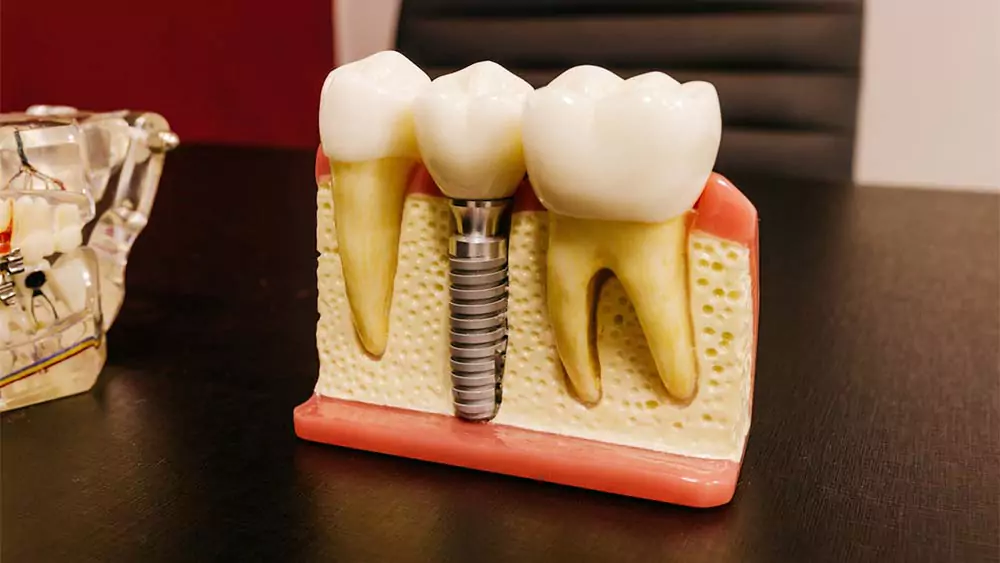 what are the latest innovations in dental implant technology